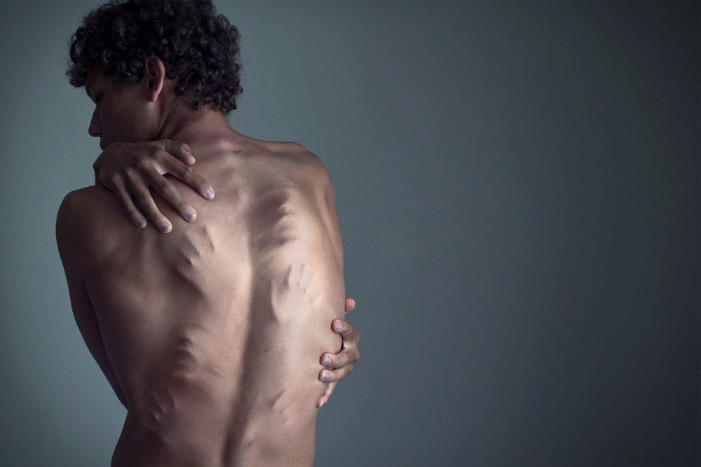 Depressão em jovens